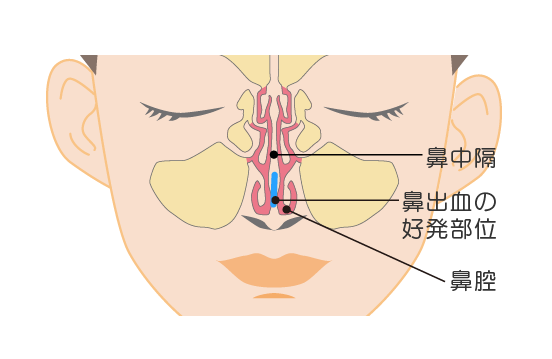 鼻出血の好発部位の説明図